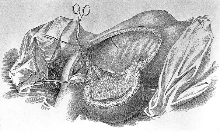 13.13 Losing a Breast to Gain a Life